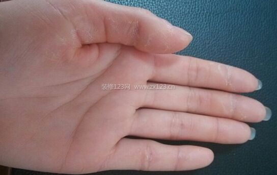 手指脫皮是缺什么