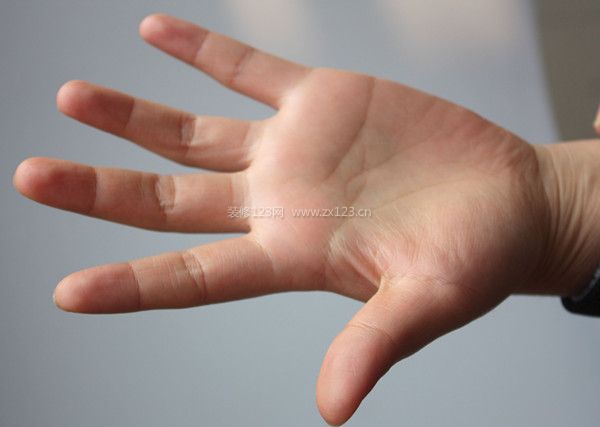 手腳出汗