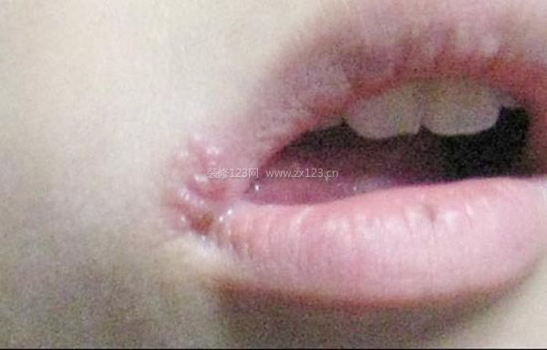 嘴唇起泡怎么辦