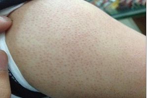 雞皮膚